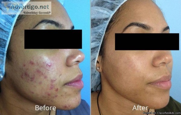 Berkowits Hydra Facial Treatment in Delhi
