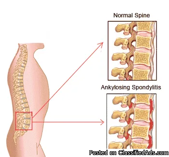 Homeopathic Medicines for Ankylosing Spondylitis Treatment