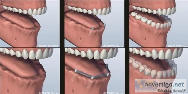 Replace Missing Tooth  Sunset Periodontics