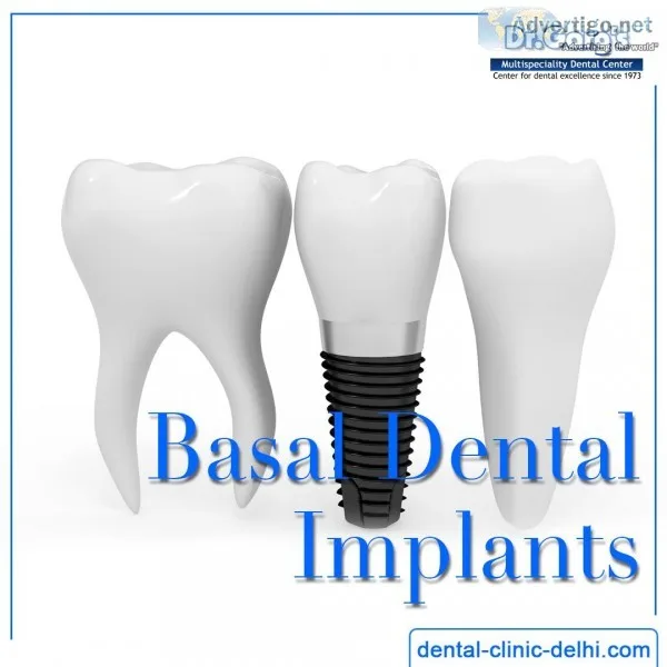 Basal Dental Implants in India