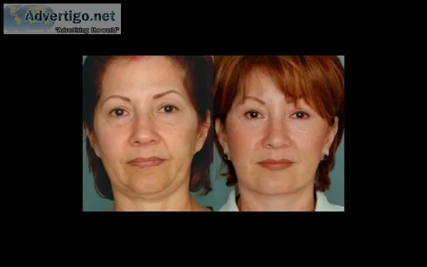 Best facelift surgeon Miami - Dr. Ramirez Plastic Surgeon