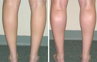 Calf Implant Cost in India  Vaidam Health