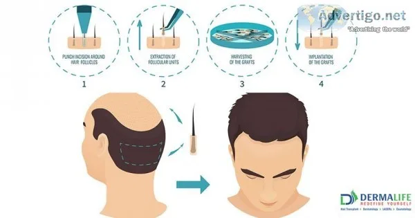 Best Dermatology and Hair Transplant surgeon in  New Delhi