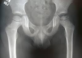 What is the treatment for Perthes disease