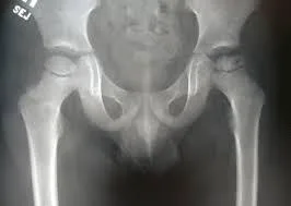 What is the treatment for Perthes disease