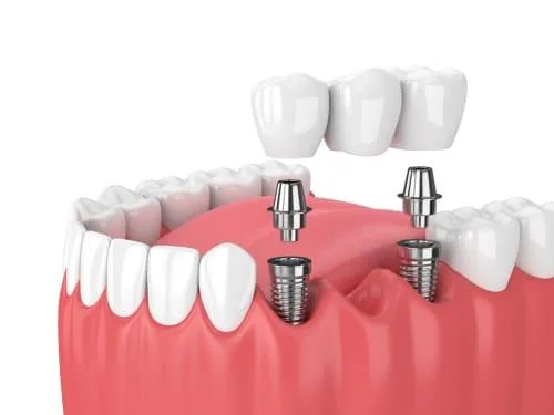 Bridges in Dentistry