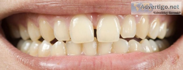 Tooth Enamel Loss Prevention Tips 
