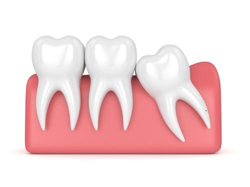 Affordable Wisdom Teeth Removal In Sydney - Wisdom Teeth Profess