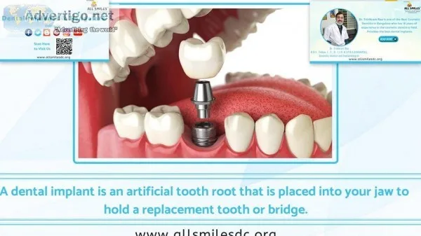 Revive Your Beautiful Teeth And Smile With Dental Implants