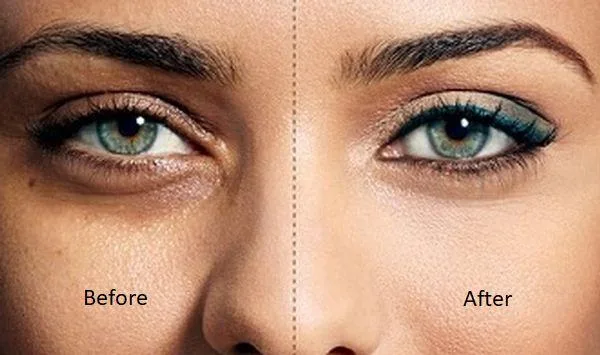 Berkowits Under Eye Dark Circles Treatment