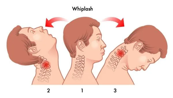Accident Whiplash Treatment