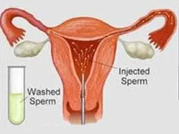 IUI Treatment in Hyderabad