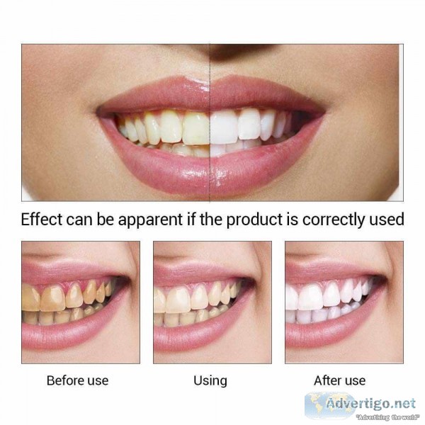 Teeth Whitening in Gurgaon- Dr. Khullar s Dental Clinic