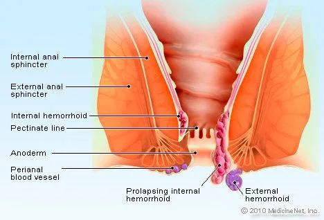piles treatment in Mumbai without operation in Mumbai