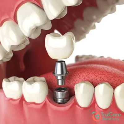 Dental Implant Dentistry In Roswell Georgia