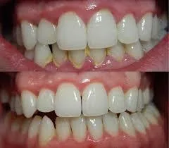 Plaque Removal Clinic in Mumbai