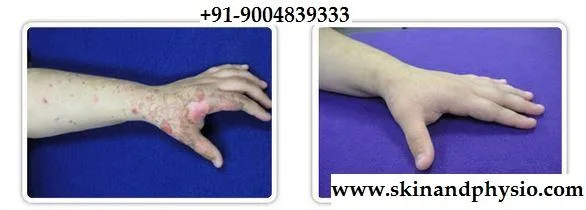 TREATMENT FOR BURN MARKS