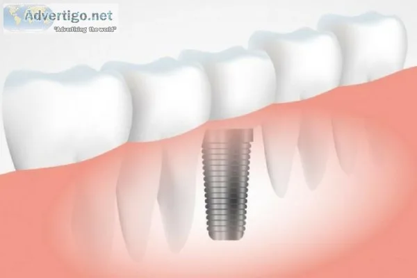 No bone implant near memumbai