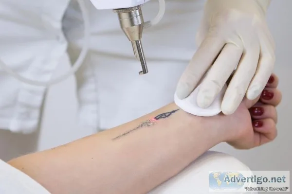 SMUK - Laser Treatments for Tattoo Removal in India