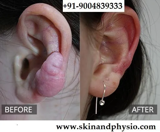 BEST TREATMENT FOR KELOID