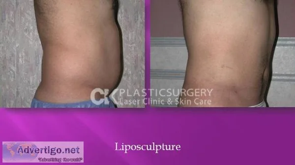 Buttock Augmentation Orange County