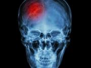 Dr. Ranga Chelva Krishna  Strokeclinicsofnyc.c om