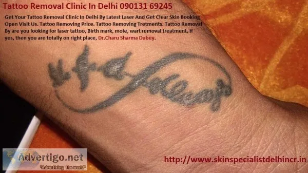 Tattoo Removal Clinic In Delhi