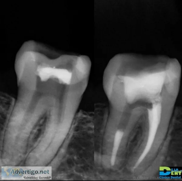 Root Canal 280 cualquier diente