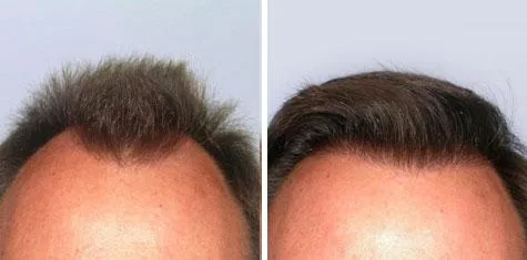 Hair Transplant Treatment in Kochi   Body Hair Transplant in Coc
