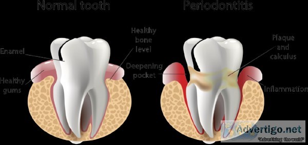 Gupta Dental Clinic Provide Periodontal Therapy