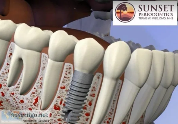 Dental Implant in Columbia Lexington SC