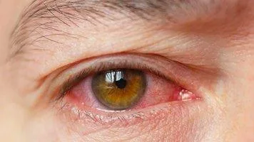 Dry Eye Treatment in Pune