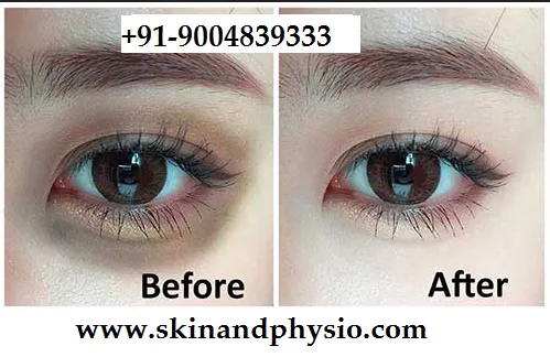 UNDER EYES DARK CIRCLES