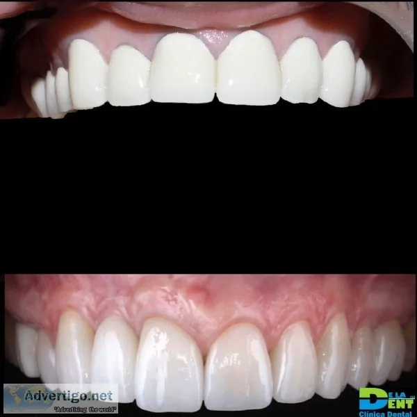 Zirconia Crowns  400