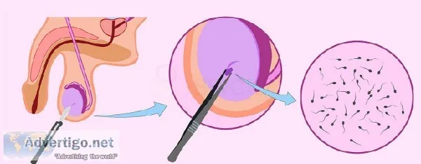 TESA and PESA Treatment in Hyderabad
