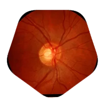 consult best doctor for Glaucoma surgery in Bangalore