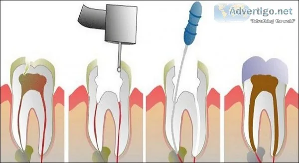 Root Canal Treatment in Delhi By Expert Dentist