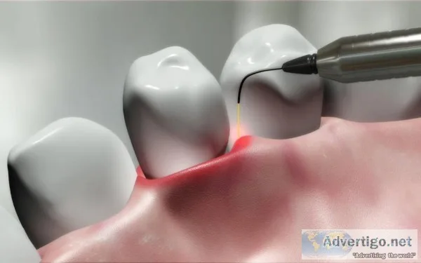 LASER IN DENTISTRY