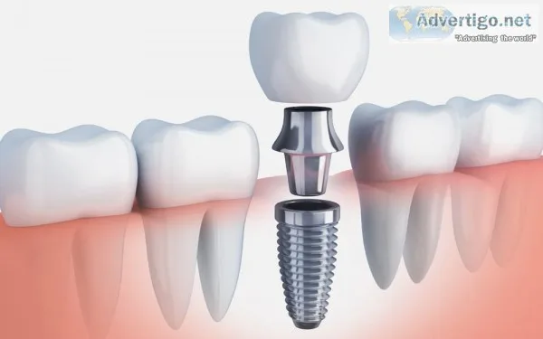 Best Implantology Course in Hyderabad