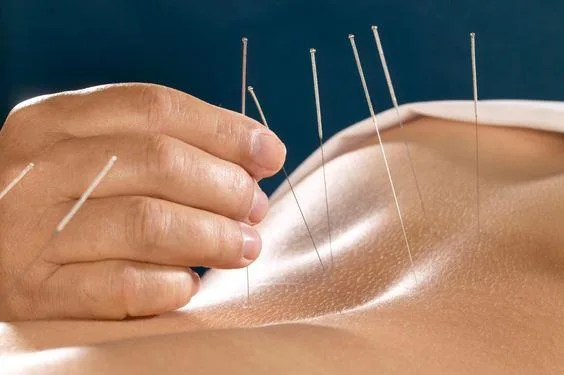 Etobicoke Acupuncture
