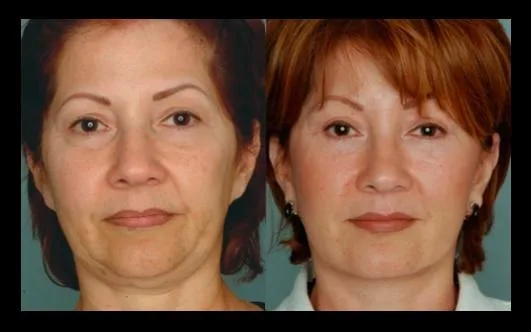 Best facelift surgeon Miami - Dr. Ramirez Plastic Surgeon