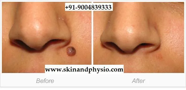 BEST TREATMENT FOR MOLE REMOVAL
