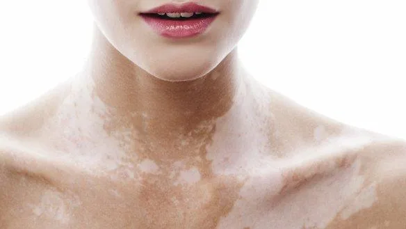 Find suitable Vitiligo Treatment in Delhi
