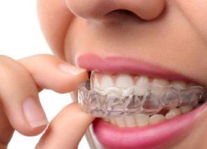 Invisalign Frisco TX