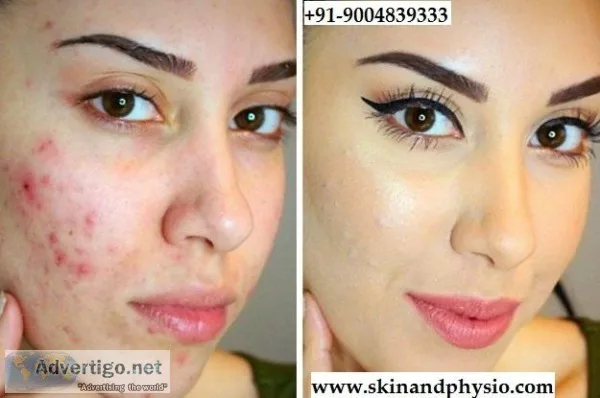 BEST TREATMENT FOR ACNE  PIMPLES