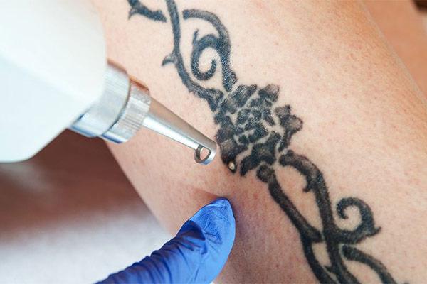 Laser Tattoo Removal