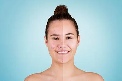 Safe and Secure Rosacea Treatment in Calgary