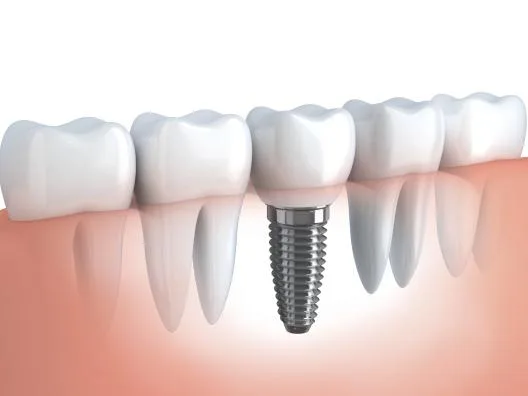 Dental Implants in Gurgaon