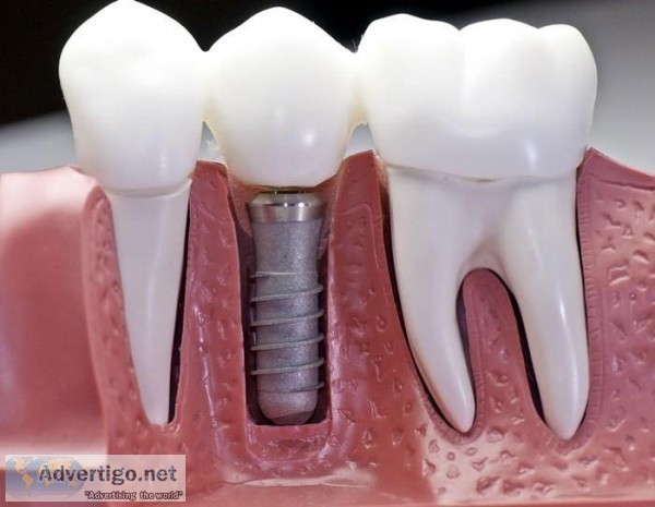 Dental Implants Mississauga  Best Tooth Replacement