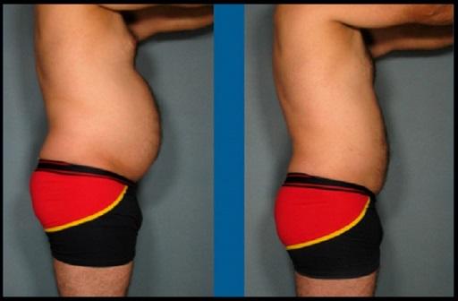 Body lift Miami - Dr. Ramirez Plastic Surgeon